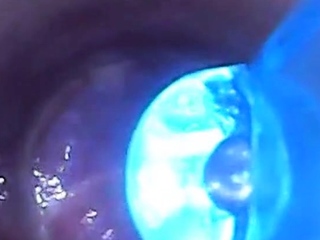 test tube cock endoscope POV urethral insertion ball rod